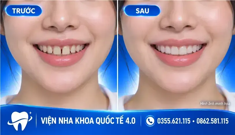 Dán sứ Veneer Emax - ảnh 2
