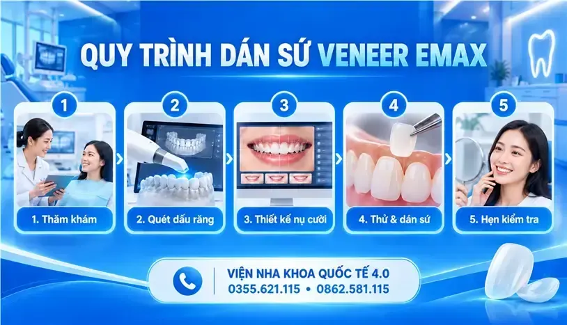 Dán sứ Veneer Emax - ảnh 3