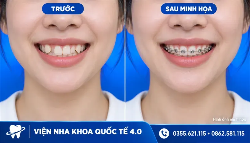 Niềng răng mắc cài - ảnh 2
