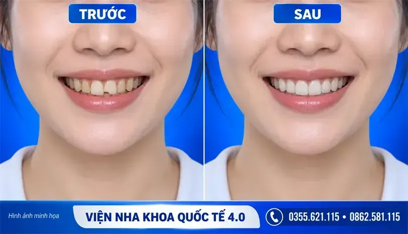 Răng sứ HT-Smile - ảnh 2