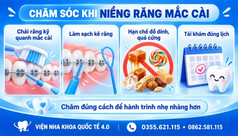 Niềng răng mắc cài - ảnh 5
