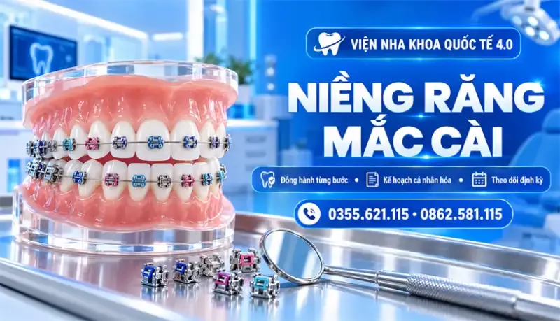 Niềng răng mắc cài